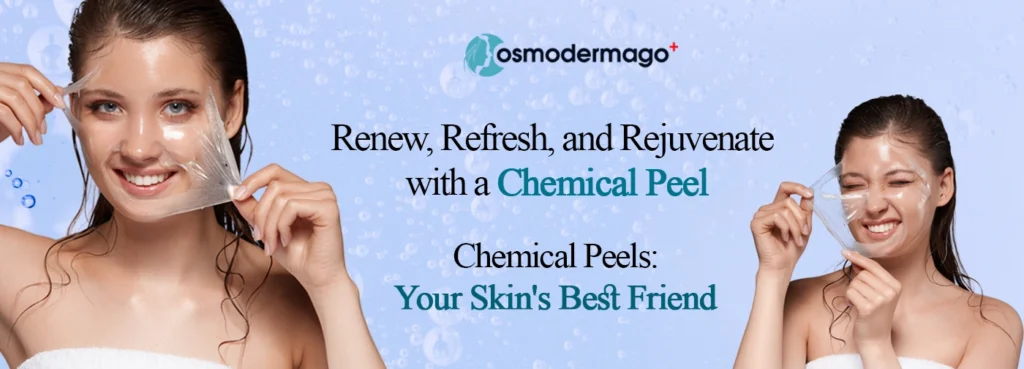 Peel Treatment